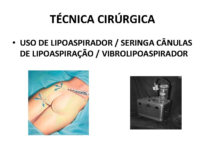 TÉCNICA CIRÚRGICA • USO DE LIPOASPIRADOR / SERINGA C NULAS DE LIPOASPIRAÇÃO / VIBROLIPOASPIRADOR