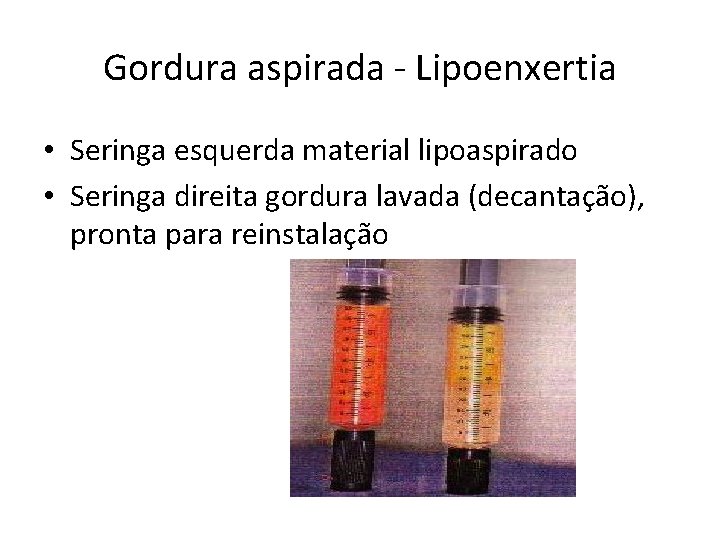 Gordura aspirada - Lipoenxertia • Seringa esquerda material lipoaspirado • Seringa direita gordura lavada