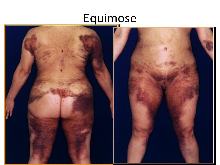 Equimose 