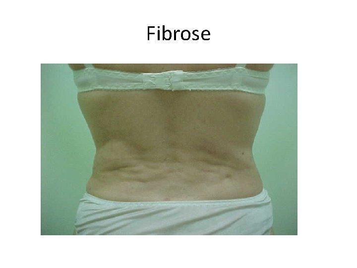 Fibrose 