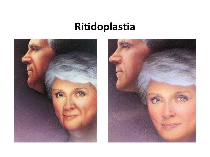 Ritidoplastia 