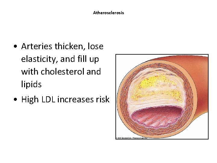 Atherosclerosis • Arteries thicken, lose elasticity, and fill up with cholesterol and lipids • Atherosclerosis • Arteries thicken, lose elasticity, and fill up with cholesterol and lipids •