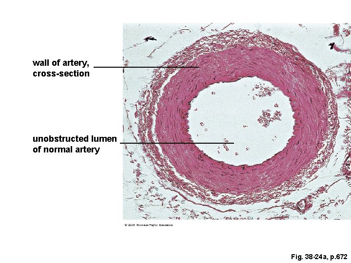 wall of artery, cross-section unobstructed lumen of normal artery Fig. 38 -24 a, p. wall of artery, cross-section unobstructed lumen of normal artery Fig. 38 -24 a, p.