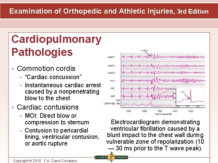 Examination of Orthopedic and Athletic Injuries, 3 rd Edition Cardiopulmonary Pathologies Commotion cordis “Cardiac