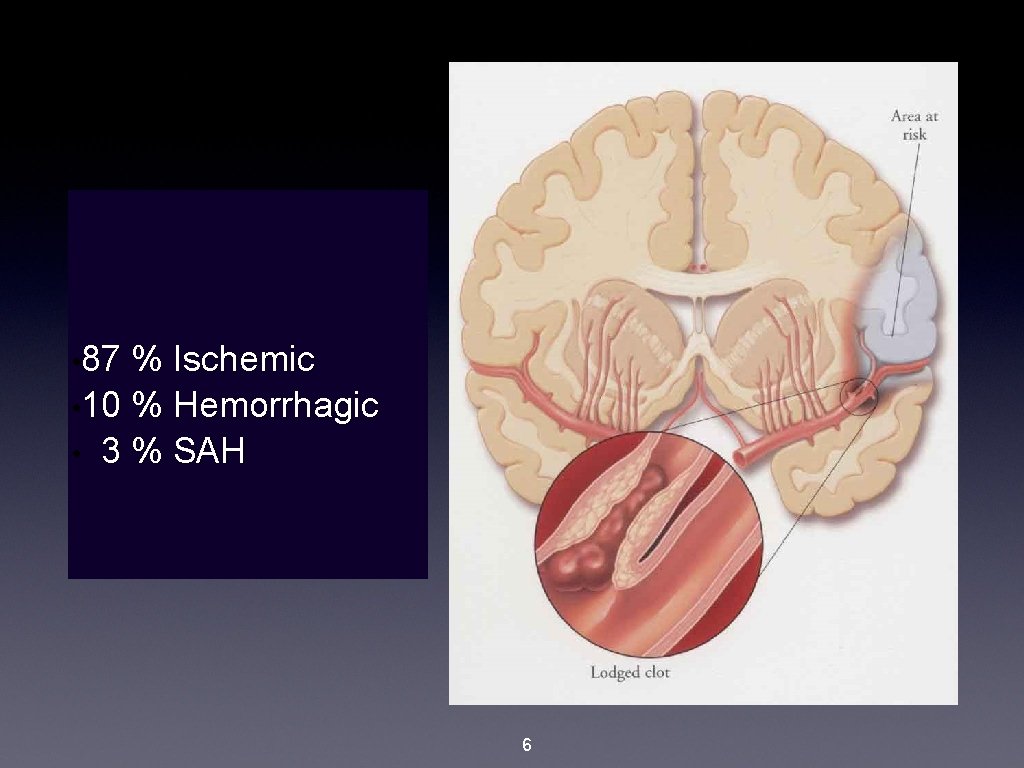  • 87 % Ischemic • 10 % Hemorrhagic • 3 % SAH 6