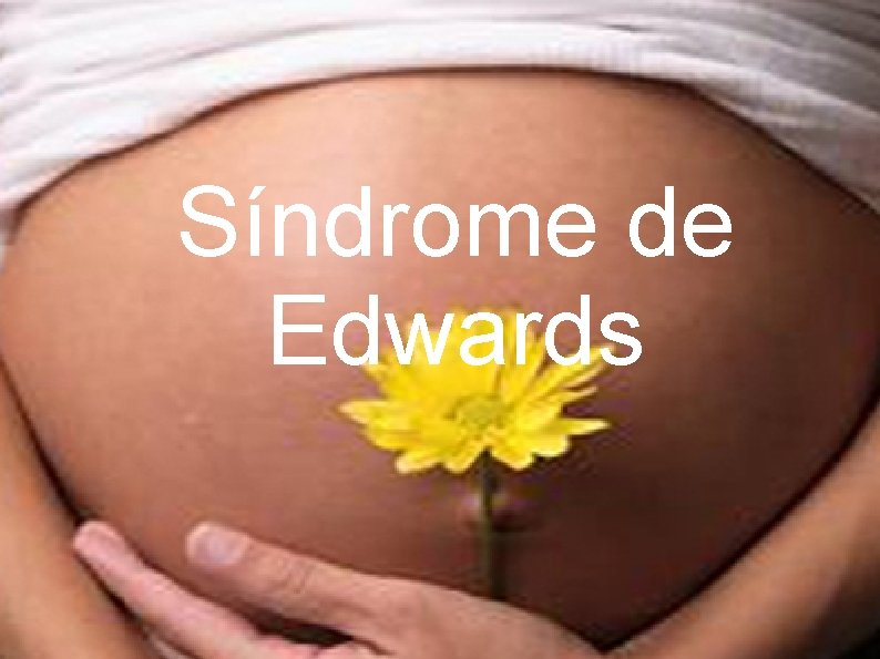 Síndrome de Edwards 