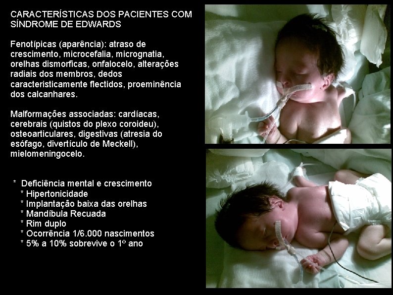 CARACTERÍSTICAS DOS PACIENTES COM SÍNDROME DE EDWARDS Fenotípicas (aparência): atraso de crescimento, microcefalia, micrognatia,