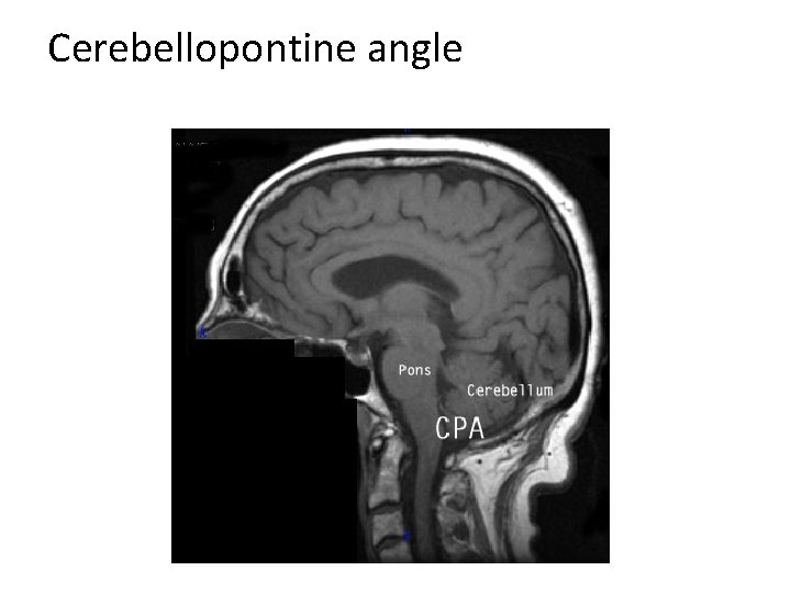 Cerebellopontine angle 