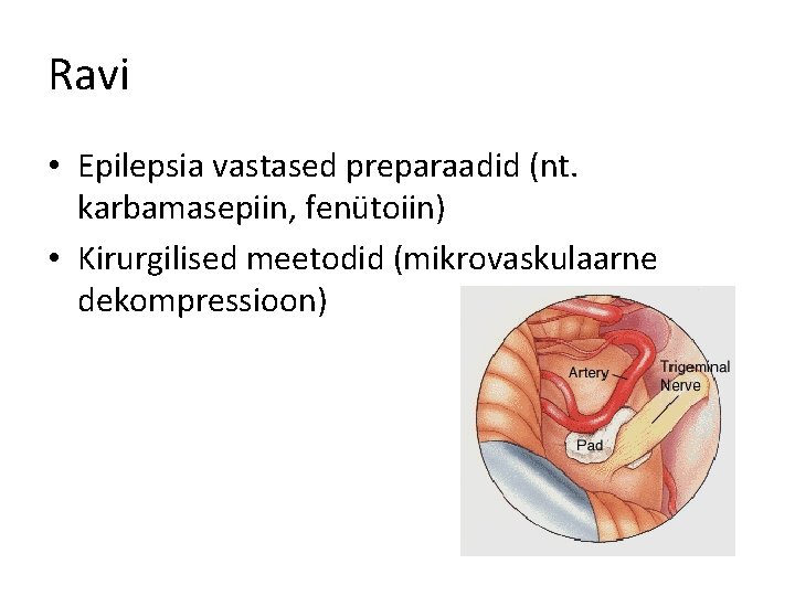 Ravi • Epilepsia vastased preparaadid (nt. karbamasepiin, fenütoiin) • Kirurgilised meetodid (mikrovaskulaarne dekompressioon) 