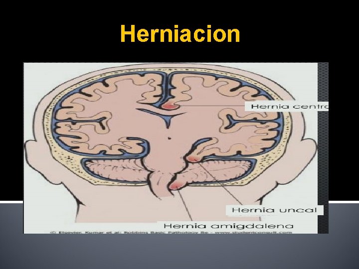 Herniacion 