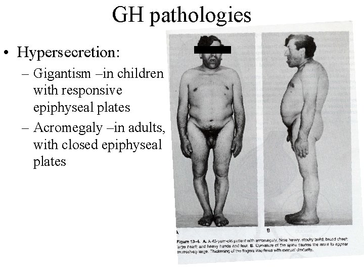 GH pathologies • Hypersecretion: – Gigantism –in children with responsive epiphyseal plates – Acromegaly