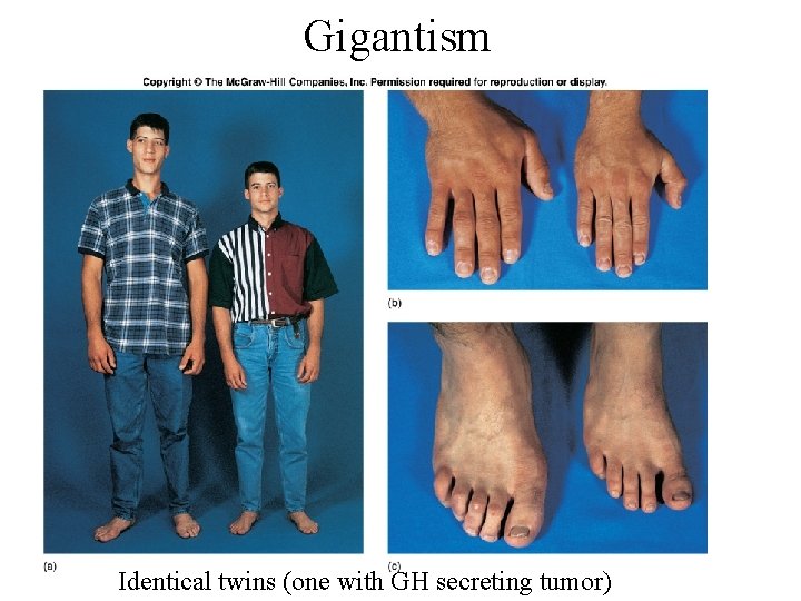 Gigantism Identical twins (one with GH secreting tumor) 