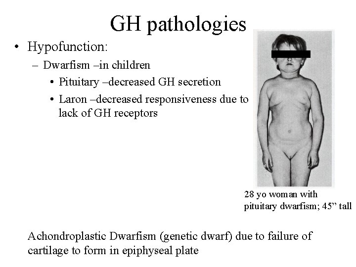 GH pathologies • Hypofunction: – Dwarfism –in children • Pituitary –decreased GH secretion •