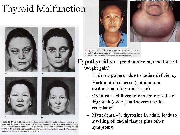 Thyroid Malfunction Hypothyroidism (cold intolerant, tend toward weight gain) – Endemic goiters –due to