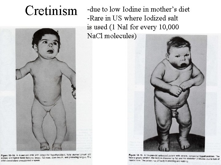 Cretinism -due to low Iodine in mother’s diet -Rare in US where Iodized salt