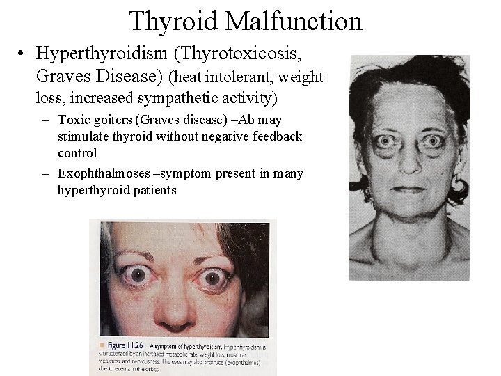 Thyroid Malfunction • Hyperthyroidism (Thyrotoxicosis, Graves Disease) (heat intolerant, weight loss, increased sympathetic activity)