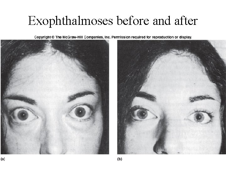 Exophthalmoses before and after 