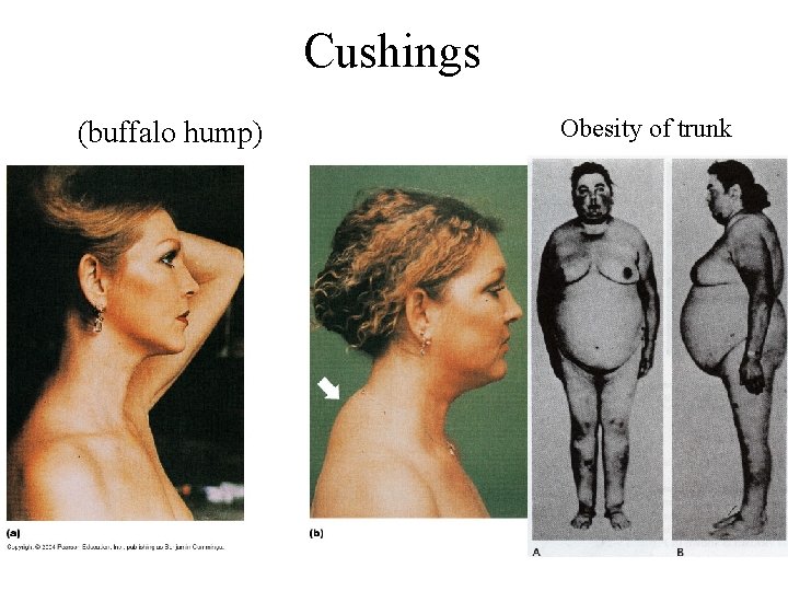Cushings (buffalo hump) Obesity of trunk 