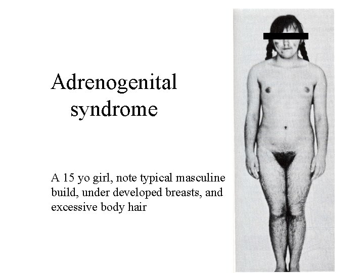 Adrenogenital syndrome A 15 yo girl, note typical masculine build, under developed breasts, and