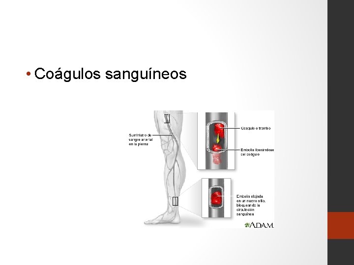  • Coágulos sanguíneos 