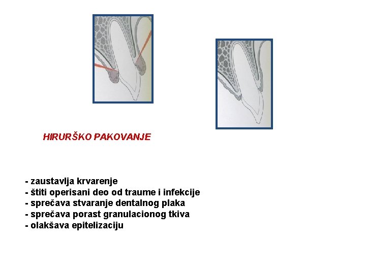 HIRURŠKO PAKOVANJE - zaustavlja krvarenje - štiti operisani deo od traume i infekcije -