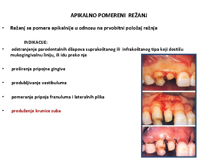 APIKALNO POMERENI REŽANJ • Režanj se pomera apikalnije u odnosu na prvobitni položaj režnja