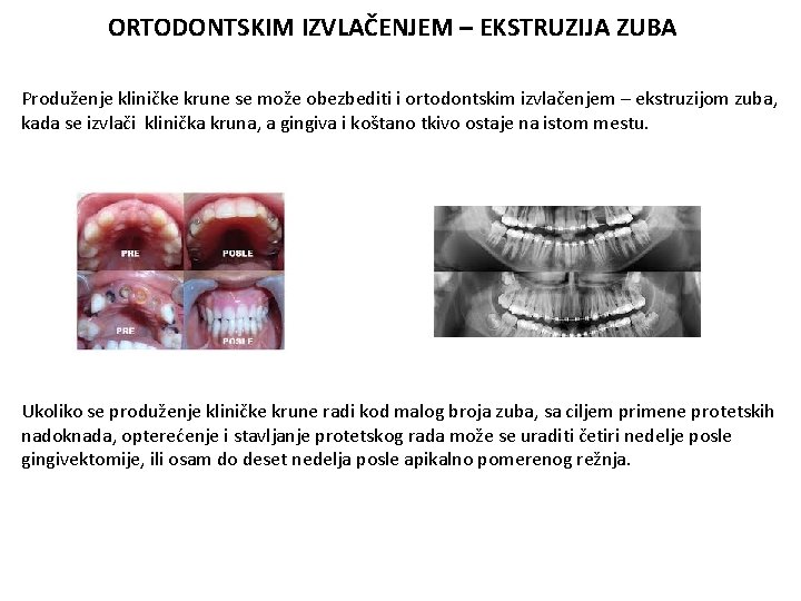 ORTODONTSKIM IZVLAČENJEM – EKSTRUZIJA ZUBA Produženje kliničke krune se može obezbediti i ortodontskim izvlačenjem