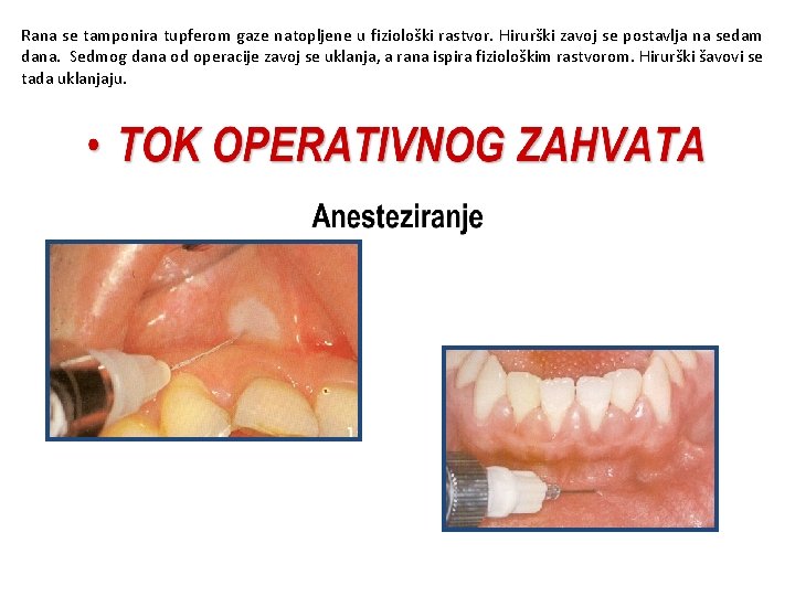 Rana se tamponira tupferom gaze natopljene u fiziološki rastvor. Hirurški zavoj se postavlja na