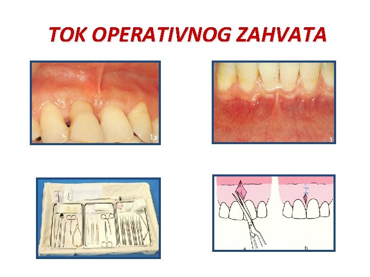 TOK OPERATIVNOG ZAHVATA 