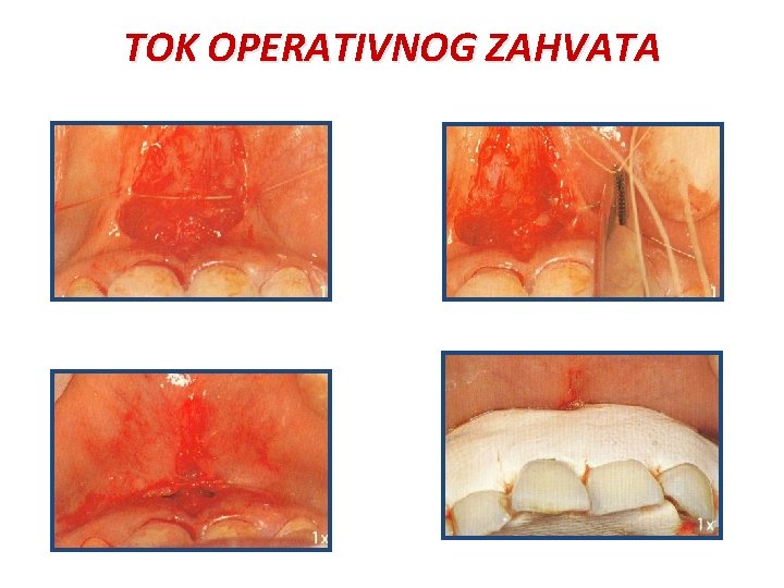 TOK OPERATIVNOG ZAHVATA 