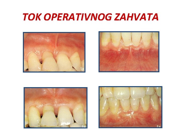 TOK OPERATIVNOG ZAHVATA TOK OPERATIVNOG ZAHVATA