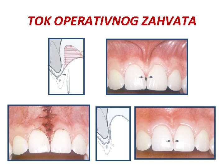 TOK OPERATIVNOG ZAHVATA 