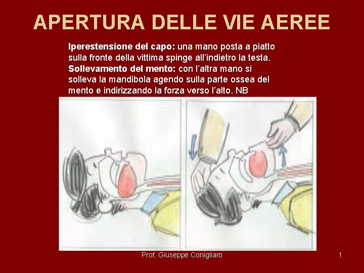 APERTURA DELLE VIE AEREE Iperestensione del capo: una mano posta a piatto sulla fronte APERTURA DELLE VIE AEREE Iperestensione del capo: una mano posta a piatto sulla fronte