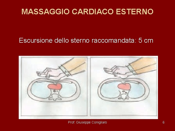 MASSAGGIO CARDIACO ESTERNO Escursione dello sterno raccomandata: 5 cm Prof. Giuseppe Conigliaro 6 MASSAGGIO CARDIACO ESTERNO Escursione dello sterno raccomandata: 5 cm Prof. Giuseppe Conigliaro 6