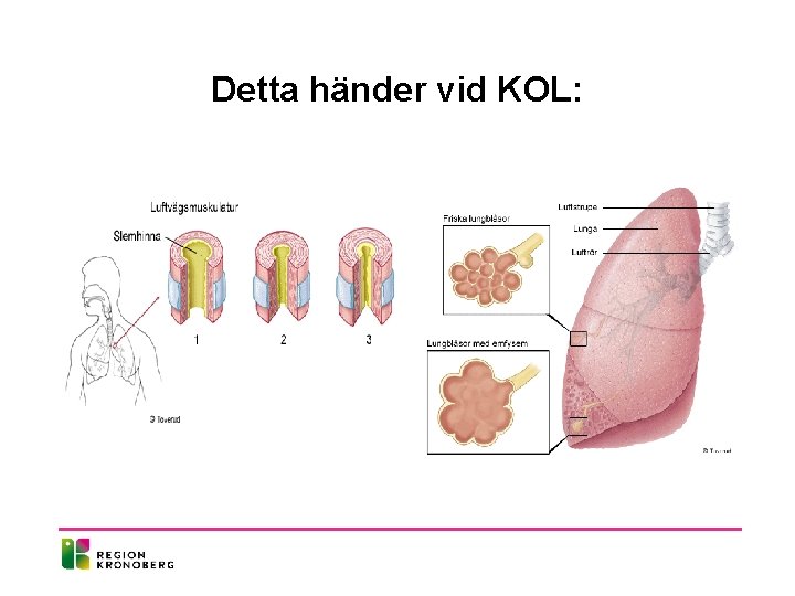 Detta händer vid KOL: 