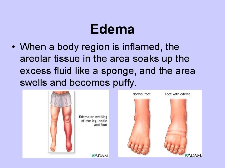 Edema • When a body region is inflamed, the areolar tissue in the area