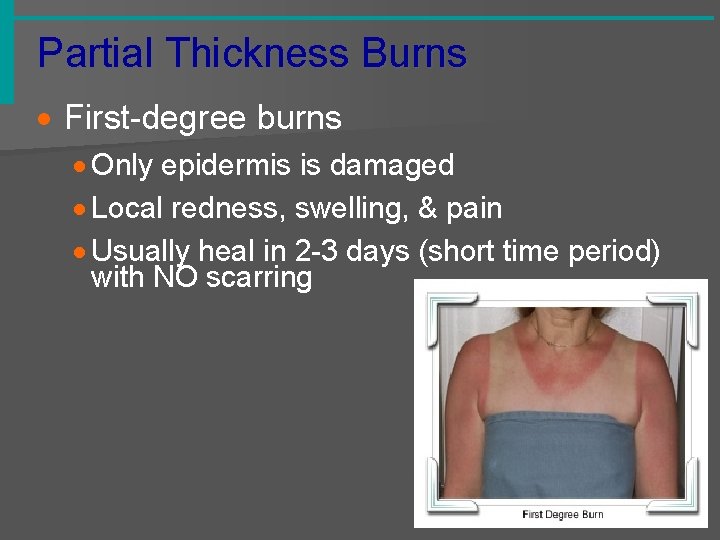 Partial Thickness Burns · First-degree burns · Only epidermis is damaged · Local redness,