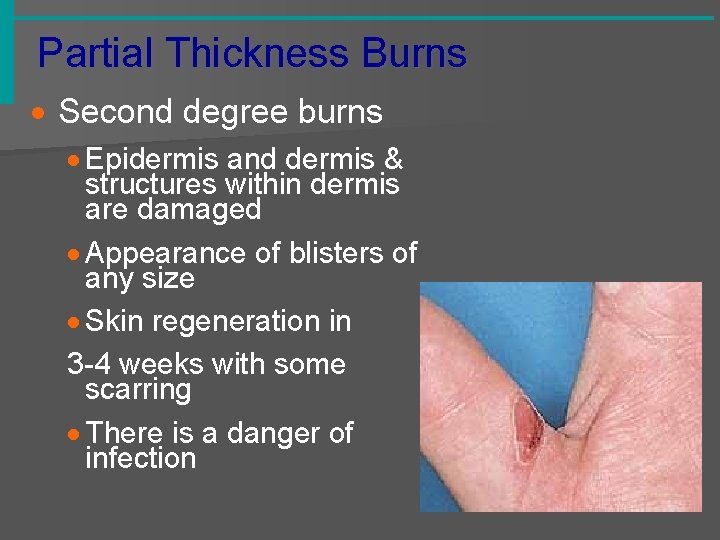 Partial Thickness Burns · Second degree burns · Epidermis and dermis & structures within