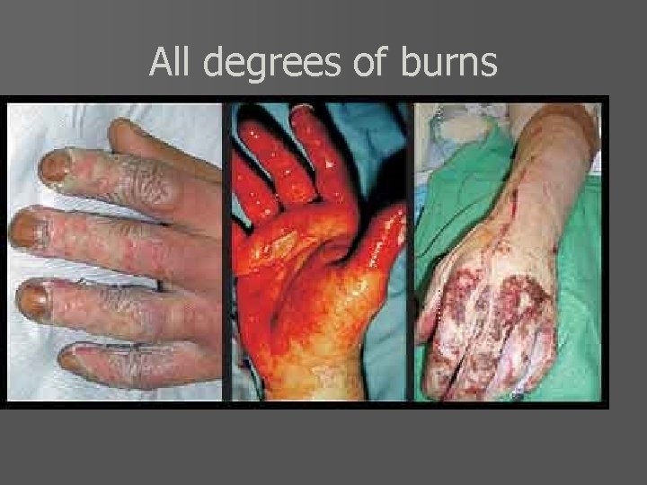 All degrees of burns 