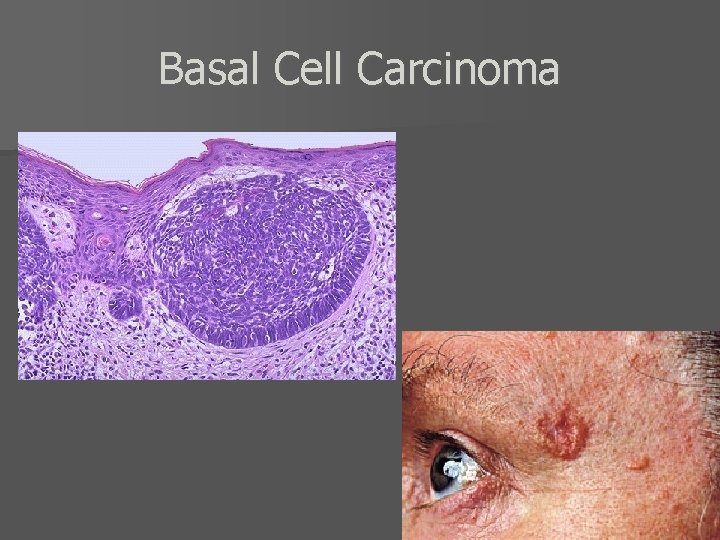 Basal Cell Carcinoma 