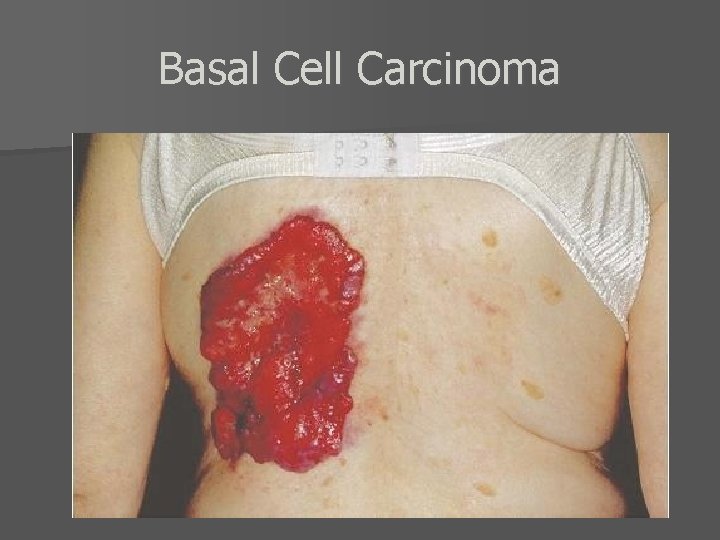 Basal Cell Carcinoma 