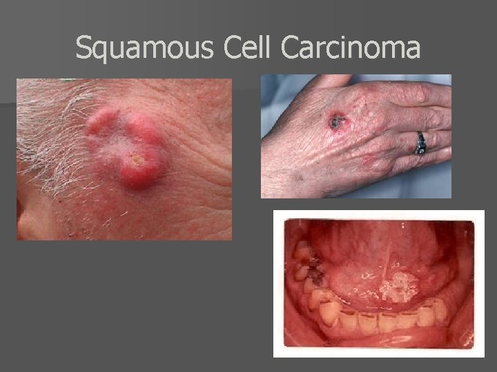 Squamous Cell Carcinoma 