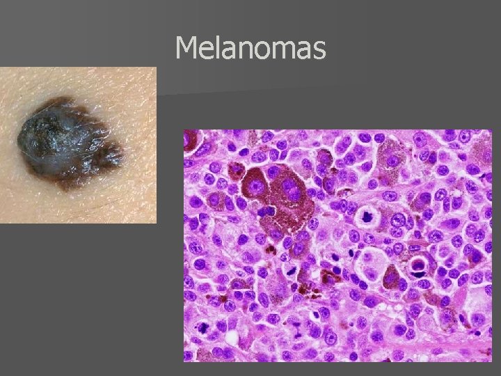 Melanomas 