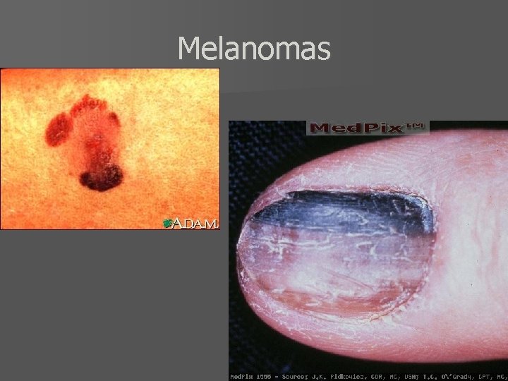 Melanomas 