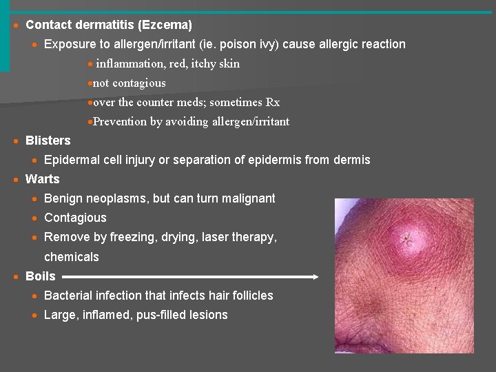 · Contact dermatitis (Ezcema) · Exposure to allergen/irritant (ie. poison ivy) cause allergic reaction