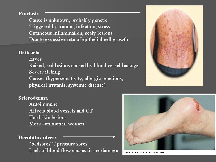 Psoriasis Cause is unknown, probably genetic Triggered by trauma, infection, stress Cutaneous inflammation, scaly