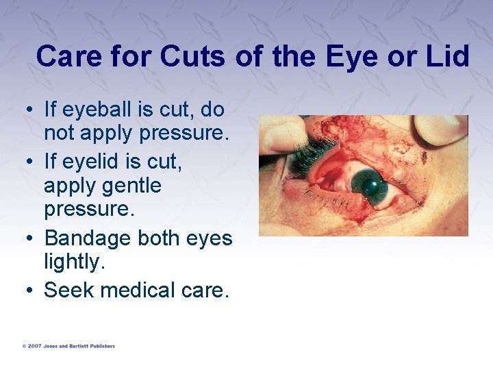 Care for Cuts of the Eye or Lid • If eyeball is cut, do