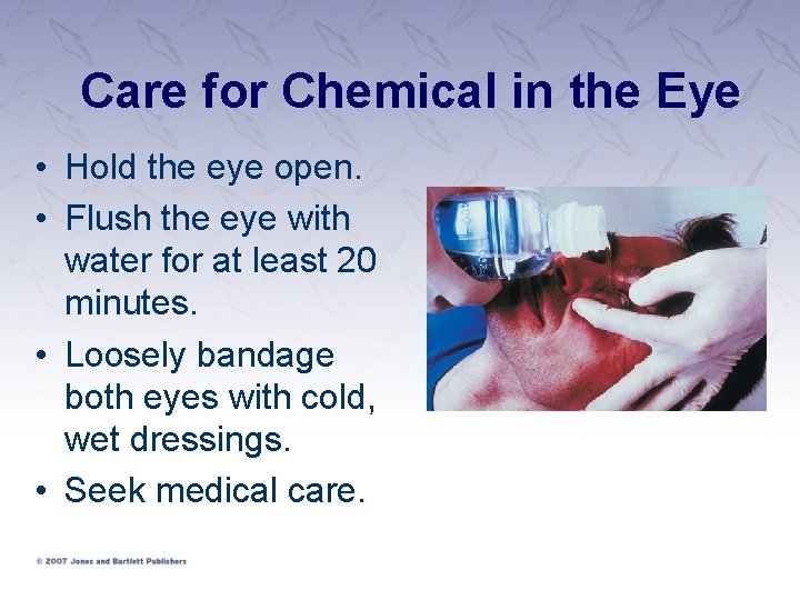 Care for Chemical in the Eye • Hold the eye open. • Flush the
