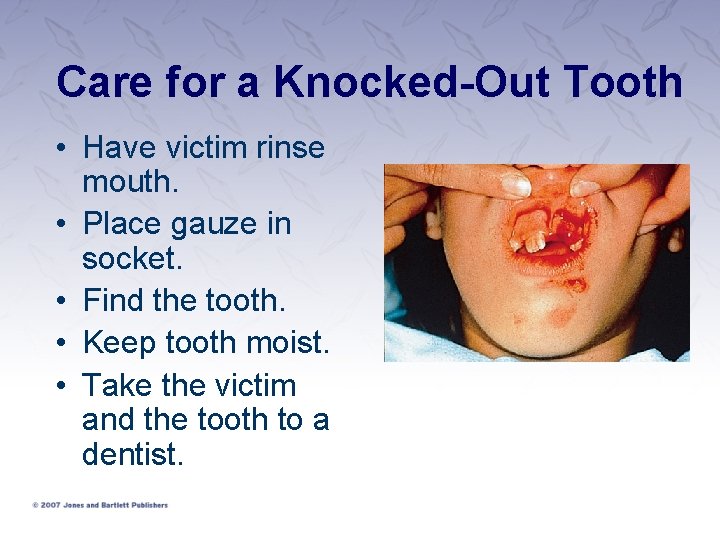 Care for a Knocked-Out Tooth • Have victim rinse mouth. • Place gauze in