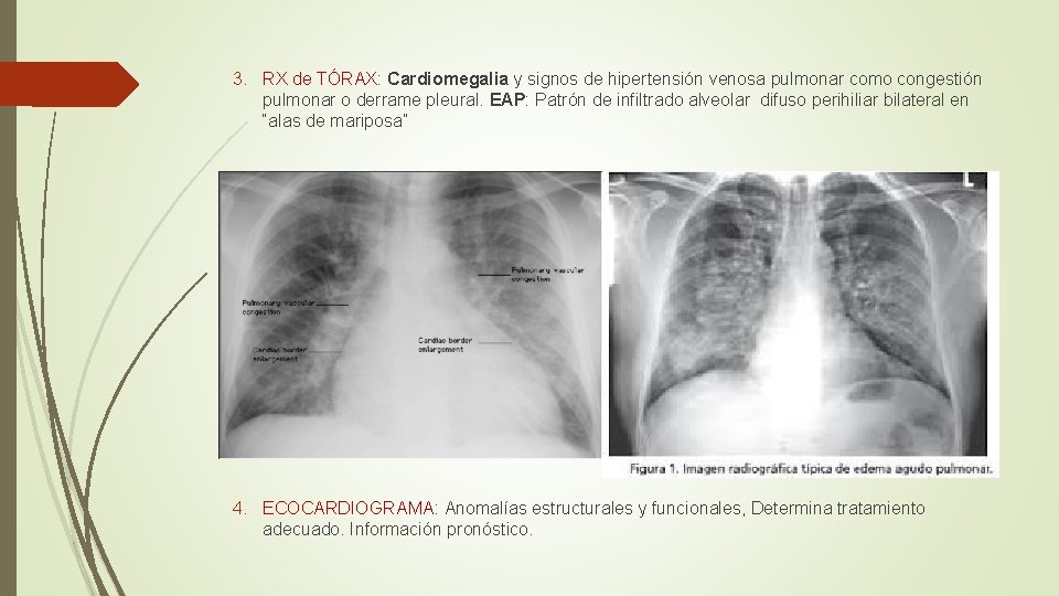 3. RX de TÓRAX: Cardiomegalia y signos de hipertensión venosa pulmonar como congestión pulmonar